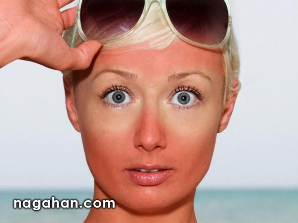 همه چیز درباره آفتاب سوختگی صورت و بدن در تابستان | علت، تسکین و درمان موثر برای رفع تیرگی پوست