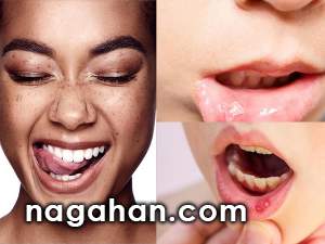 درمان آفت یا زخم  های دهان در سریع ترین زمان ممکن